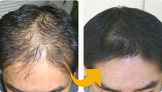 生え際薄毛を発毛治療で改善された２０代男性