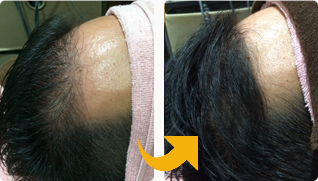 M字薄毛から発毛治療で改善された４０代男性