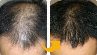 細くなった毛を育毛治療で改善した３０代男性