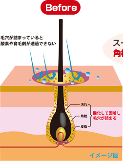 皮脂のBefore