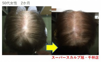 大阪の薄毛治療