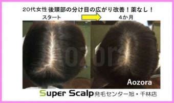 ２０代女性の薄毛 Faga 改善の方法まとめ 大阪で薄毛対策ならaozoraスーパースカルプ旭千林店 男性女性のaga