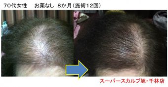 ７０代女性の薄毛 Faga 改善の方法まとめ 大阪で薄毛対策ならaozoraスーパースカルプ旭千林店 男性女性のaga