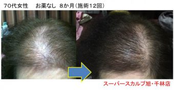 ７０代女性の薄毛 Faga 改善の方法まとめ 大阪で薄毛対策aozoraスーパースカルプ大阪梅田店 旭千林店 男性女性のaga