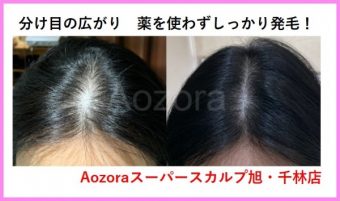 ５０代女性の薄毛 Faga 改善の方法まとめ 大阪で薄毛対策ならaozoraスーパースカルプ旭千林店 男性女性のaga