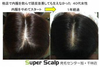 ミノキシジルを中止し再発毛での改善症例 大阪で薄毛対策ならaozoraスーパースカルプ旭千林店 男性女性のaga