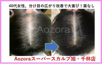 ４０代女性の薄毛 Faga 改善の方法まとめ 大阪で薄毛対策aozoraスーパースカルプ大阪梅田店 旭千林店 男性女性のaga