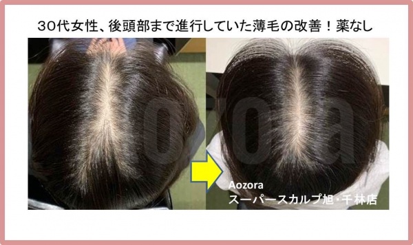 ３０代女性の薄毛改善の方法まとめ 大阪で薄毛対策ならaozoraスーパースカルプ旭千林店 男性女性のaga