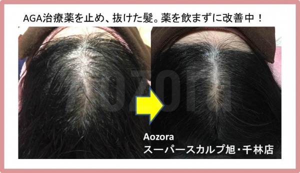 ３０代女性の薄毛改善の方法まとめ 大阪で薄毛対策ならaozoraスーパースカルプ旭千林店 男性女性のaga