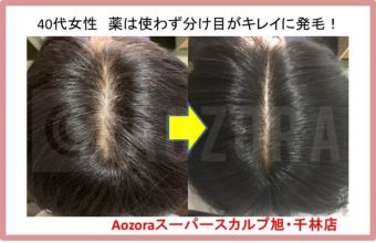 ４０代女性の薄毛 Faga 改善の方法まとめ 大阪で薄毛対策ならaozoraスーパースカルプ旭千林店 男性女性のaga