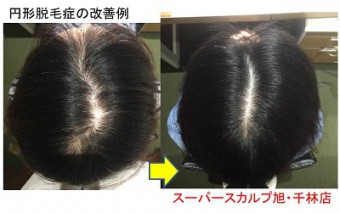 女性の薄毛治療は薬を飲む前にスーパースカルプ旭千林店へ 大阪で薄毛対策ならaozoraスーパースカルプ旭千林店 男性女性のaga