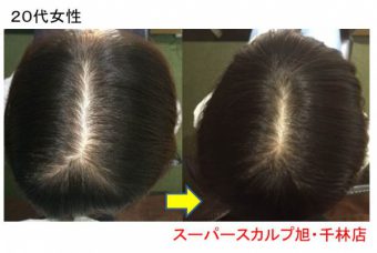 スタッフブログ 大阪で薄毛対策ならaozoraスーパースカルプ旭千林店 男性女性のaga