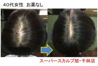 ４０代女性の薄毛 Faga 改善の方法まとめ 大阪で薄毛対策ならaozoraスーパースカルプ旭千林店 男性女性のaga
