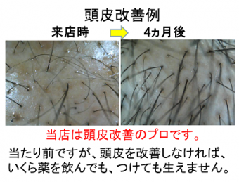 スーパースカルプ薄毛改善例