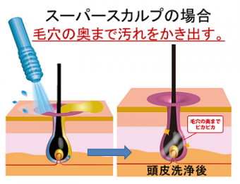 スーパースカルプの頭皮洗浄