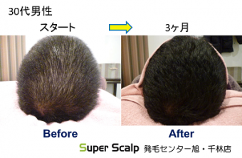 薄毛の悩みが大阪で解決しました