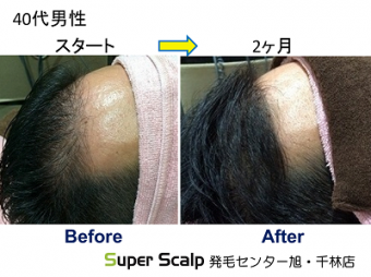 スーパースカルプ発毛療法で生え際が後退してきた　40代男性