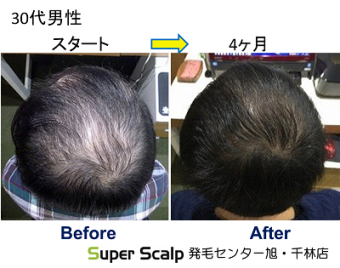 スーパースカルプ発毛療法で7年前からてっぺんの薄毛が気になりだした　30代男性