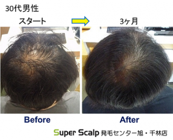 20歳から薄毛で悩んできた　30代男性